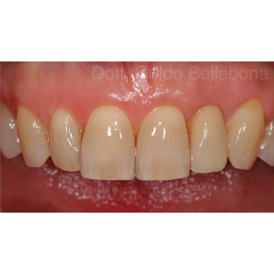 Impianto in Zirconia 